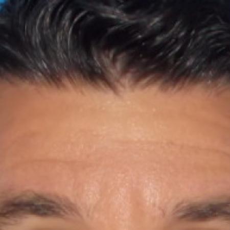 Before Case #88336 - Botox to Forehead
