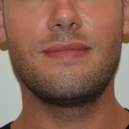 Before image 1 Case #107881 - Male Facial Contouring with Morpheus8