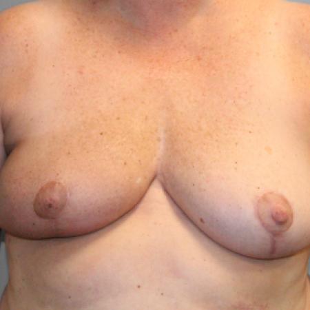 After image 1 Case #107816 - Breast Reconstruction