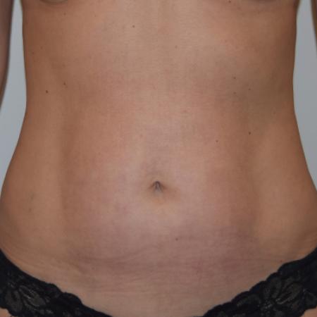 After image 1 Case #105271 - Liposuction, Cellfina, BodyTite & Morpheus8