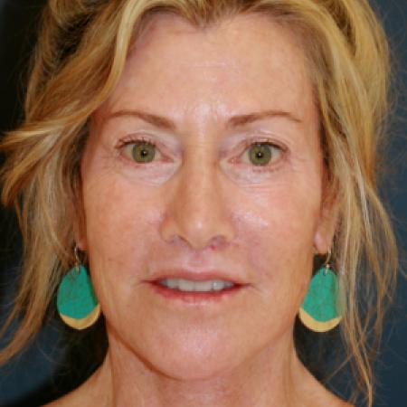 After image 1 Case #109666 - Female Facial Rejuvenation