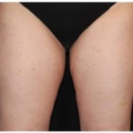 After Case #86361 - 45 yr old treated with nonsurgical fat reduction.