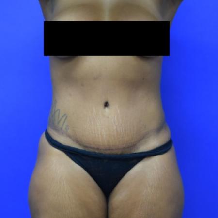 After image 1 Case #110106 - Drainless tummy tuck with liposuction