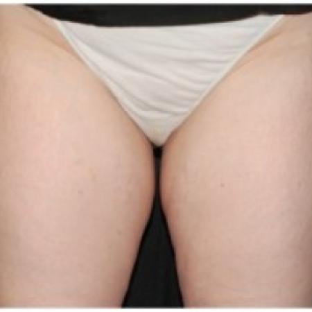 Before Case #86361 - 45 yr old treated with nonsurgical fat reduction.