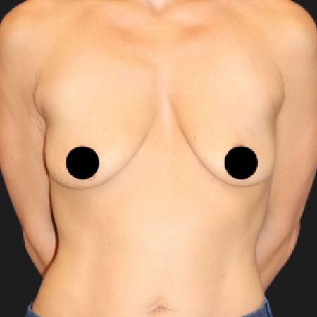 Before image 1 Case #109846 - 44 year-old breast augmentation and lift