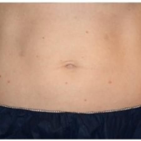 After Case #86356 - 40 yr old treated with nonsurgical fat reduction.