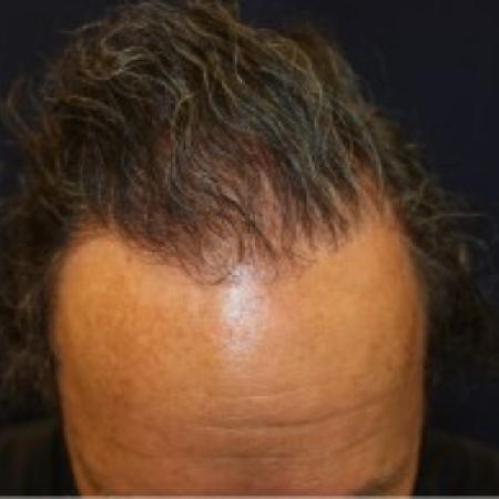 After Case #87381 - Hair Transplantation San Diego