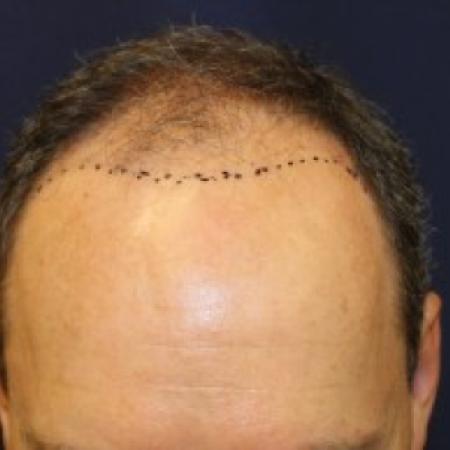 Before Case #87381 - Hair Transplantation San Diego