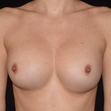 Before Case #109361 - Breast Replacement & Revision