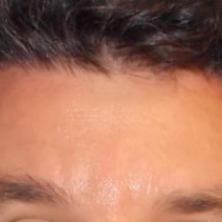 After Case #88336 - Botox to Forehead
