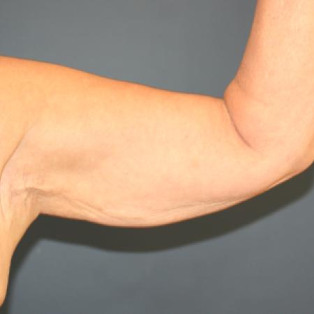 Before image 1 Case #109946 - Female Upper Arm Lift (Brachioplasty)