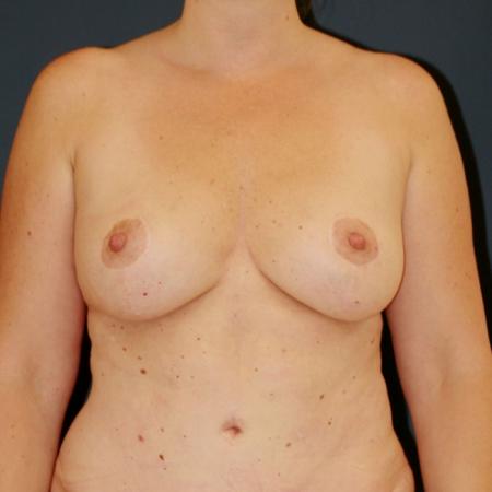 After image 1 Case #110071 - Donut Breast Lift
