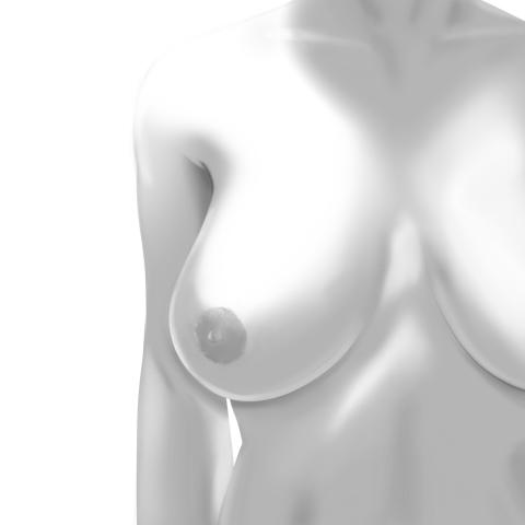 Breast Reduction before