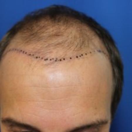 Before Case #87396 - Hair Transplantation San Diego