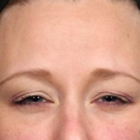 After Case #86811 - 35-45 year old woman treated with Botox