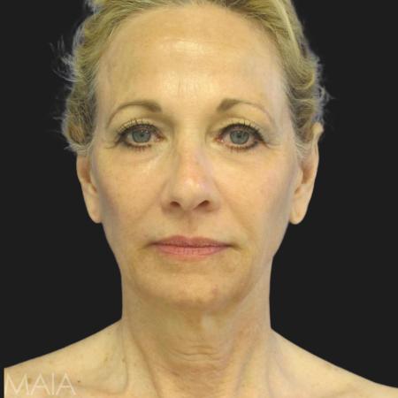 Before image 1 Case #109806 - 67 year-old before and after facial rejuvenation