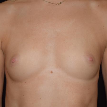 Before image 1 Case #110161 - Endoscopic Breast Augmentation (255cc)