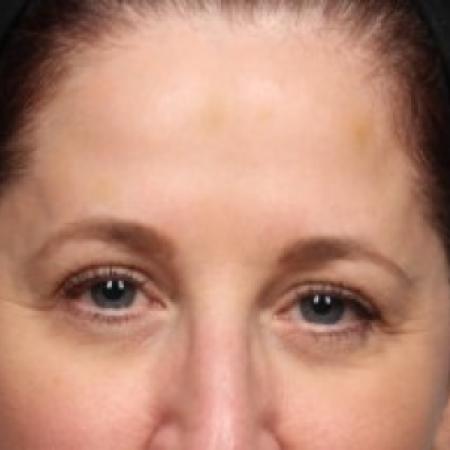 After Case #86806 - 55-64 year old woman treated with Botox