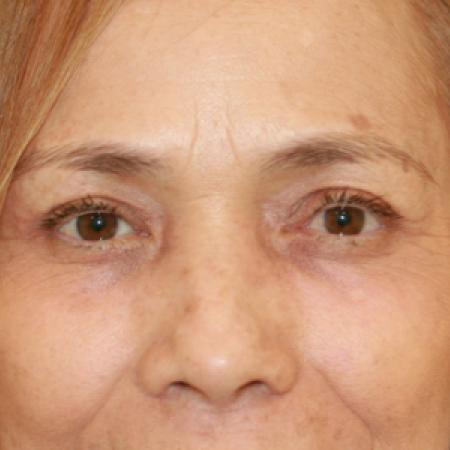 After Case #109526 - Female Upper Eye Lift (Blepharoplasty)
